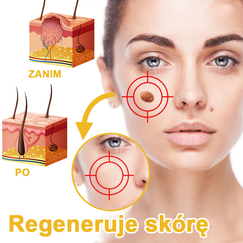 🌿🌿Krem FROPUN™ do usuwania brodawek i znamion z jadem pszczelim🔥(Ostatni dzień promocji 80% zniżki）
