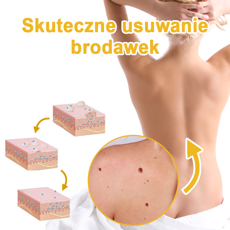 🌿🌿Krem FROPUN™ do usuwania brodawek i znamion z jadem pszczelim🔥(Ostatni dzień promocji 80% zniżki）