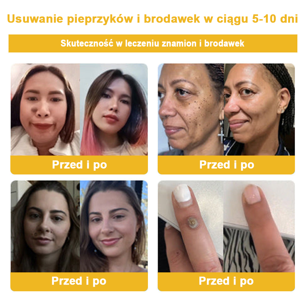 🌿🌿Krem FROPUN™ do usuwania brodawek i znamion z jadem pszczelim🔥(Ostatni dzień promocji 80% zniżki）