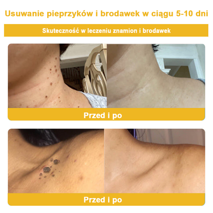 🌿🌿Krem FROPUN™ do usuwania brodawek i znamion z jadem pszczelim🔥(Ostatni dzień promocji 80% zniżki）