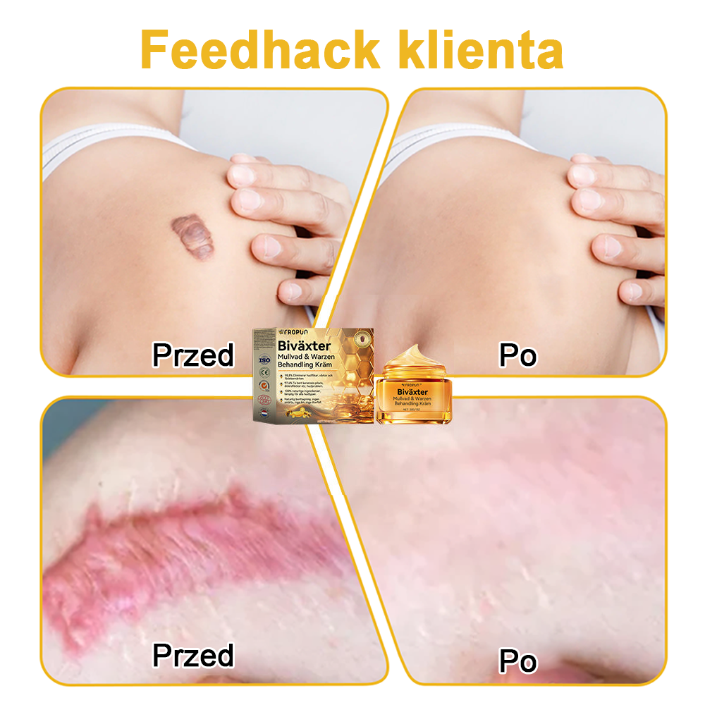 🌿🌿Krem FROPUN™ do usuwania brodawek i znamion z jadem pszczelim🔥(Ostatni dzień promocji 80% zniżki）