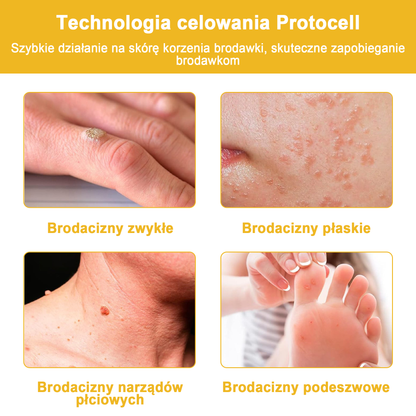 🌿🌿Krem FROPUN™ do usuwania brodawek i znamion z jadem pszczelim🔥(Ostatni dzień promocji 80% zniżki）