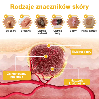 🌿🌿Krem FROPUN™ do usuwania brodawek i znamion z jadem pszczelim🔥(Ostatni dzień promocji 80% zniżki）